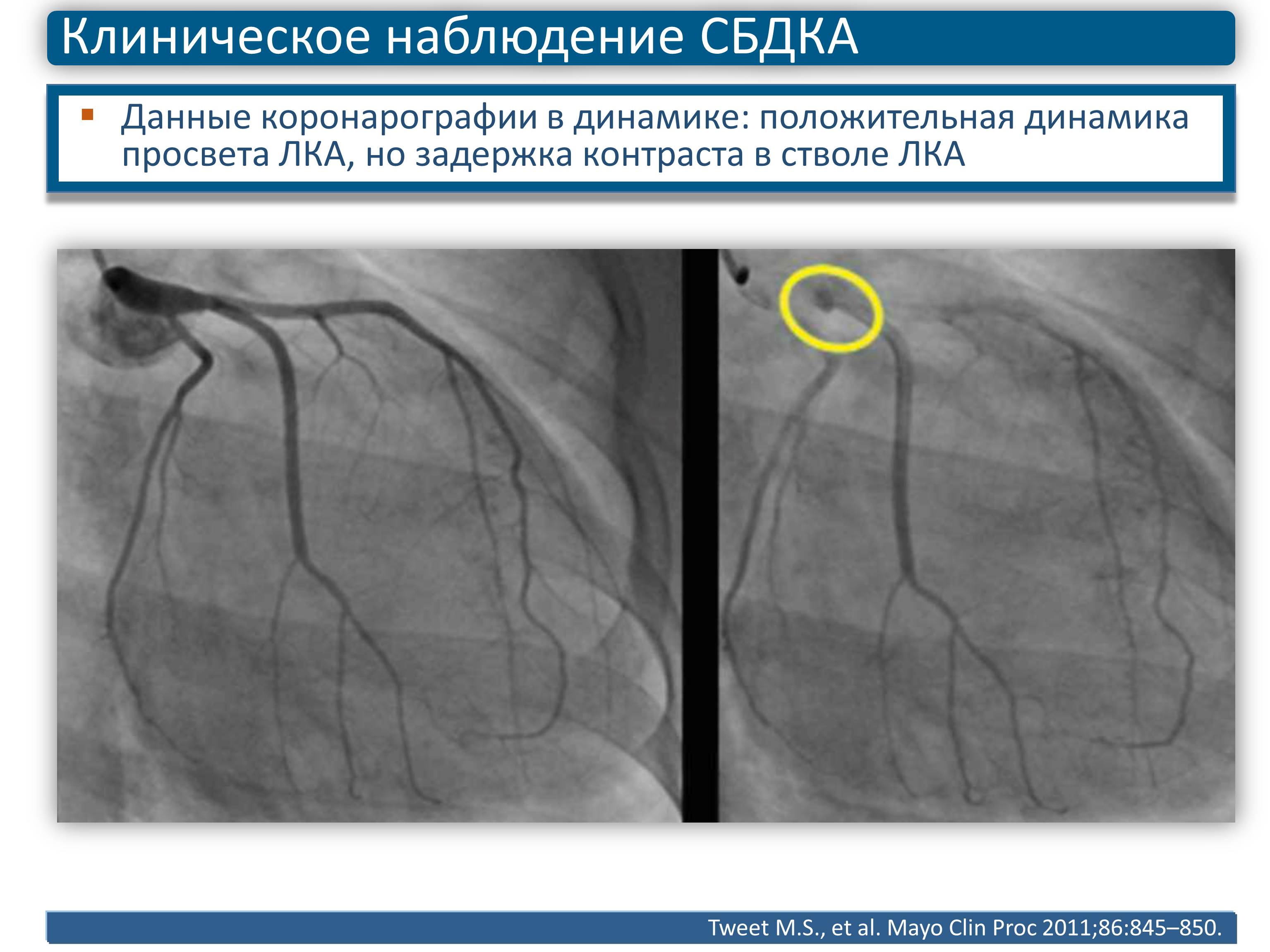 Коронарография фото с описанием патологии