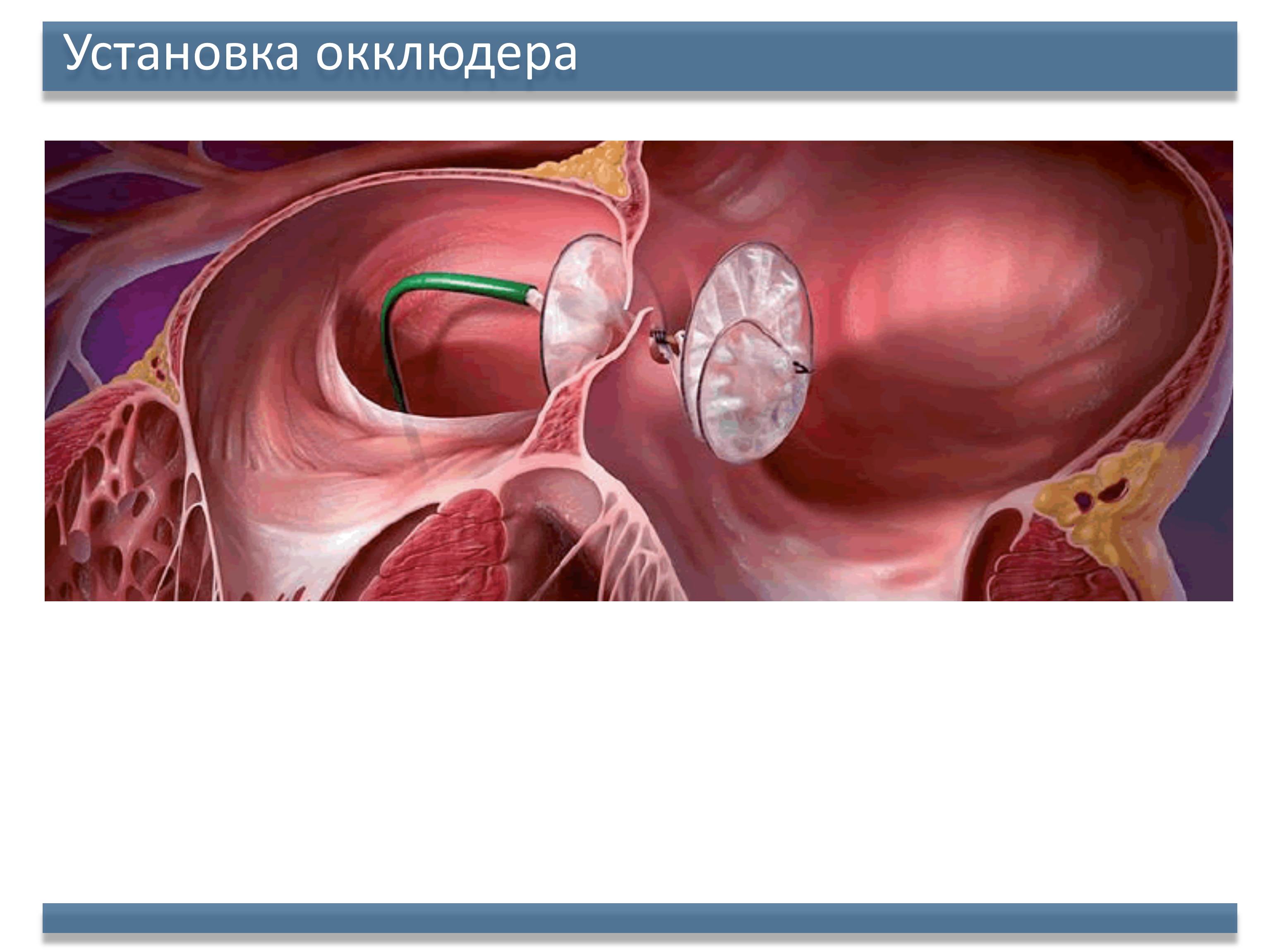 Ушивания дефекта межпредсердной перегородки