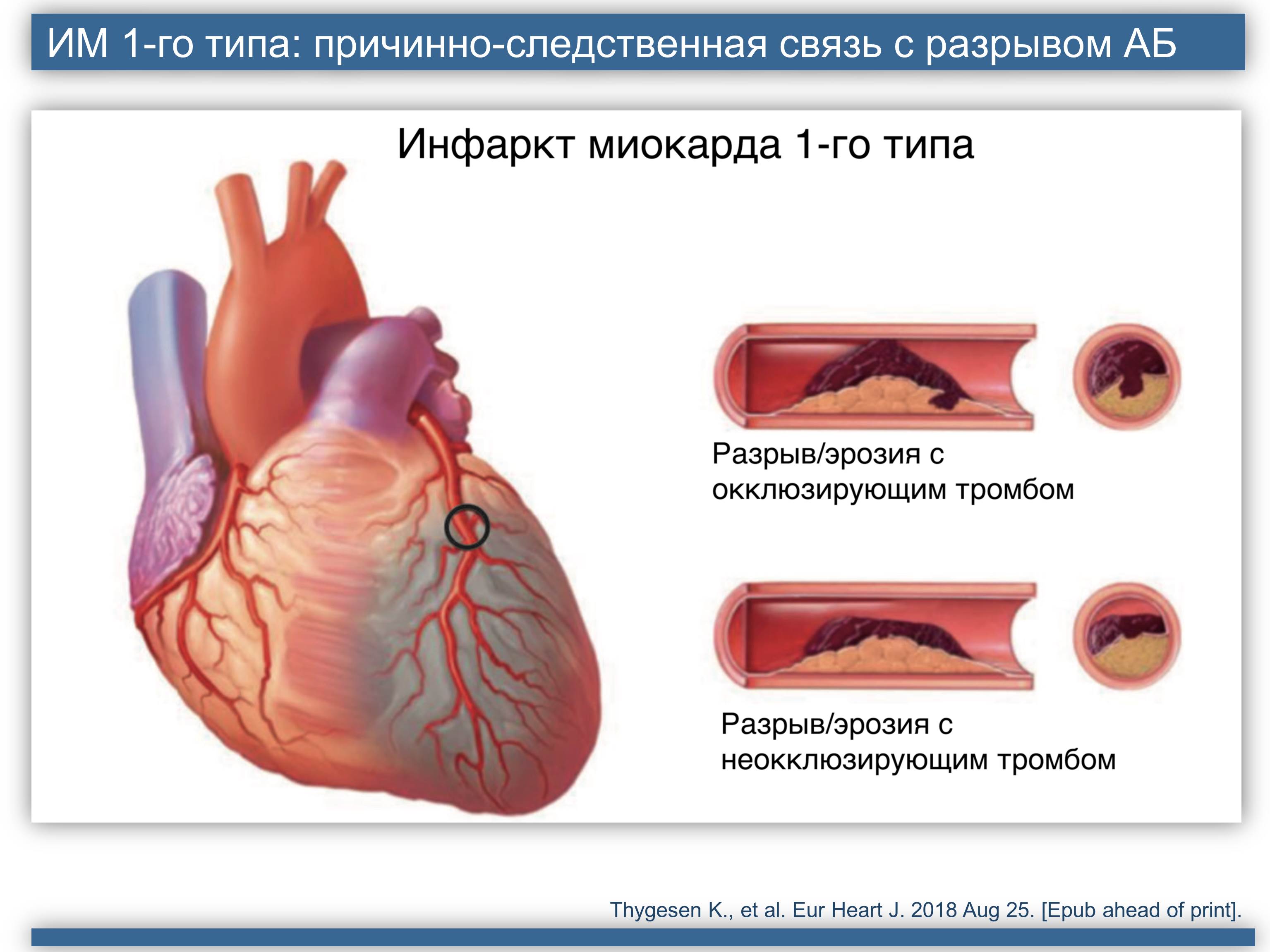 Этиология инфаркта миокарда типы