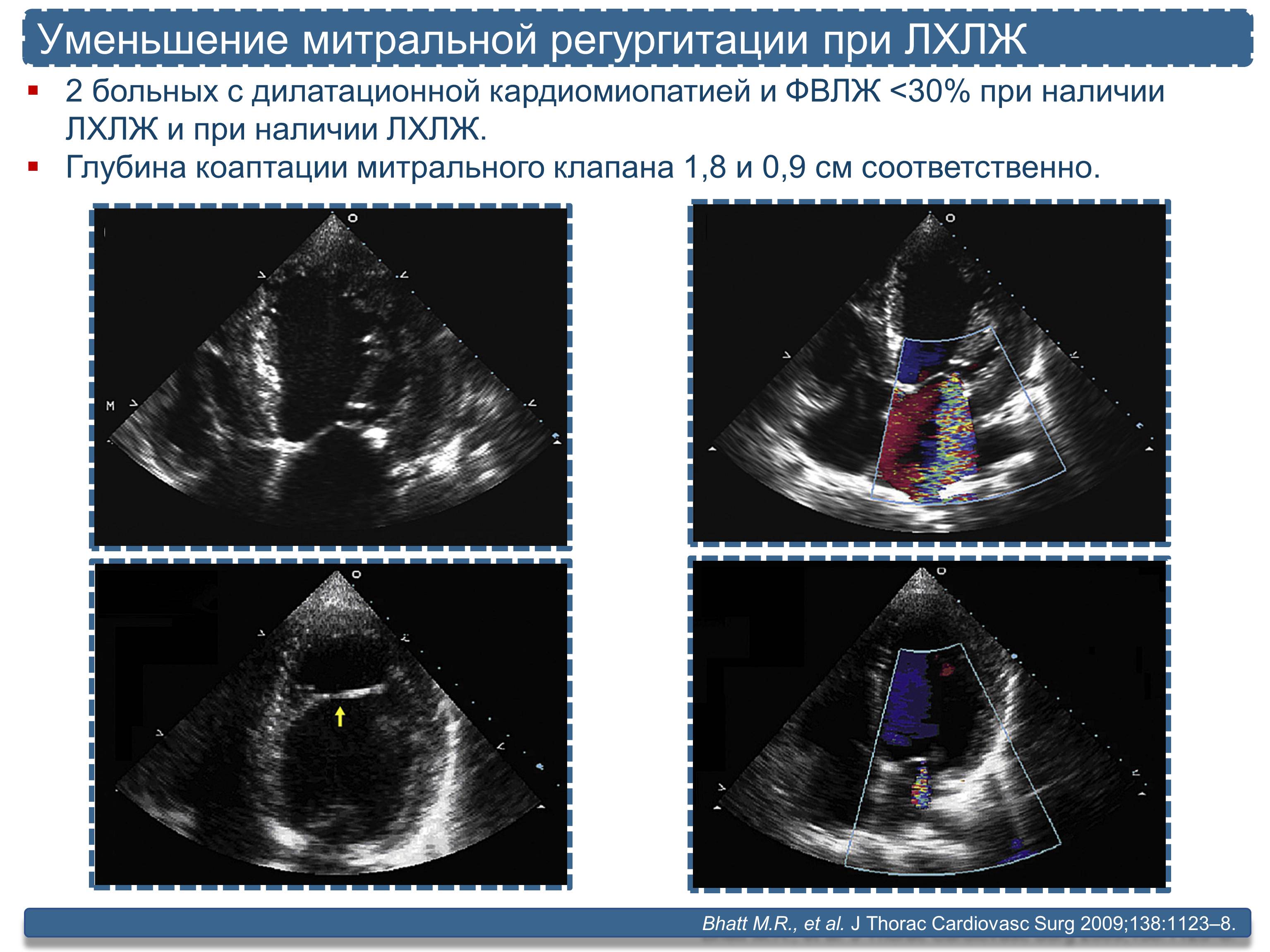 Митральная регургитация 1 степени что это. УЗИ сердца при дилатационной кардиомиопатии. Конфигурация сердца при дилатационной кардиомиопатии. Глубина коаптации створок митрального клапана. Хирургическое лечение при дилатационной кардиомиопатии.