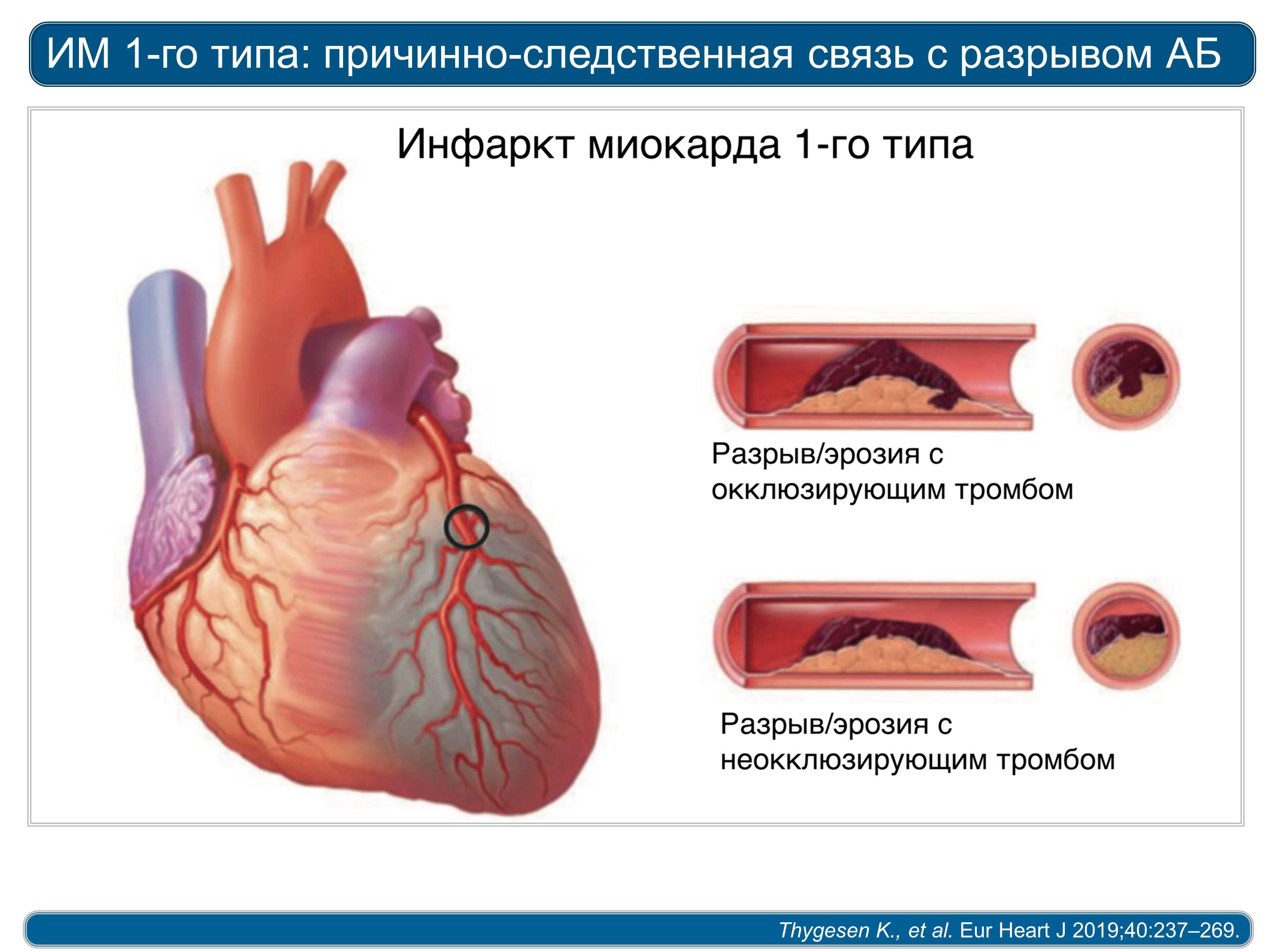 Инфаркт левого. Этиология инфаркта миокарда типы. 1 Тип острого инфаркта миокарда это.