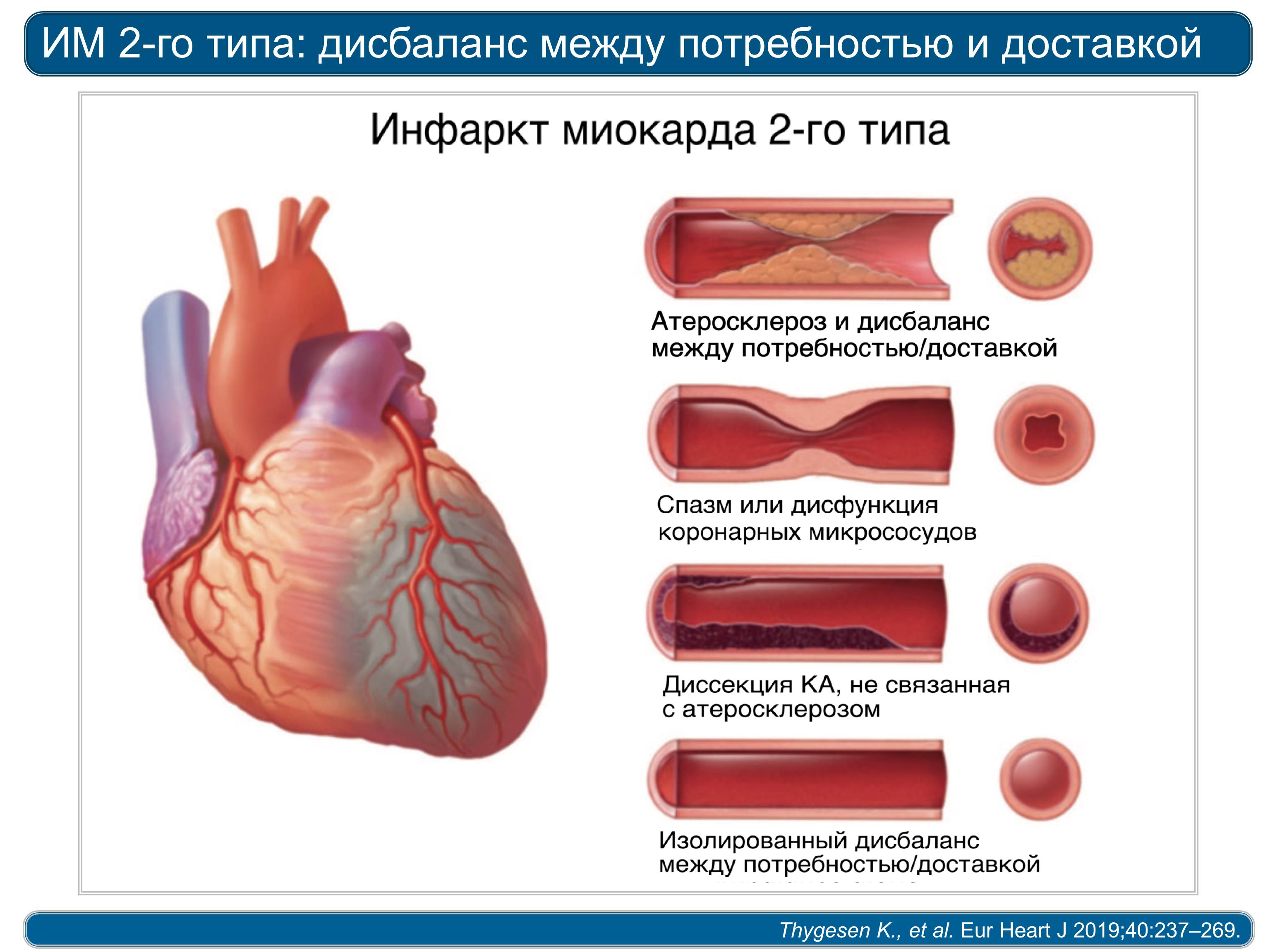 Типы инфаркта миокарда классификация 2020
